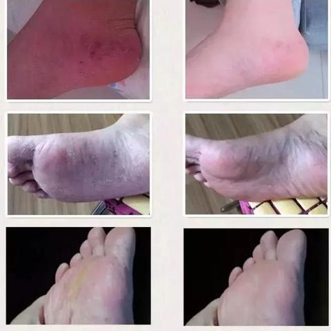 脚上如何分辨是湿疹还是脚气（脚上怎么分辨是湿疹还是过敏）